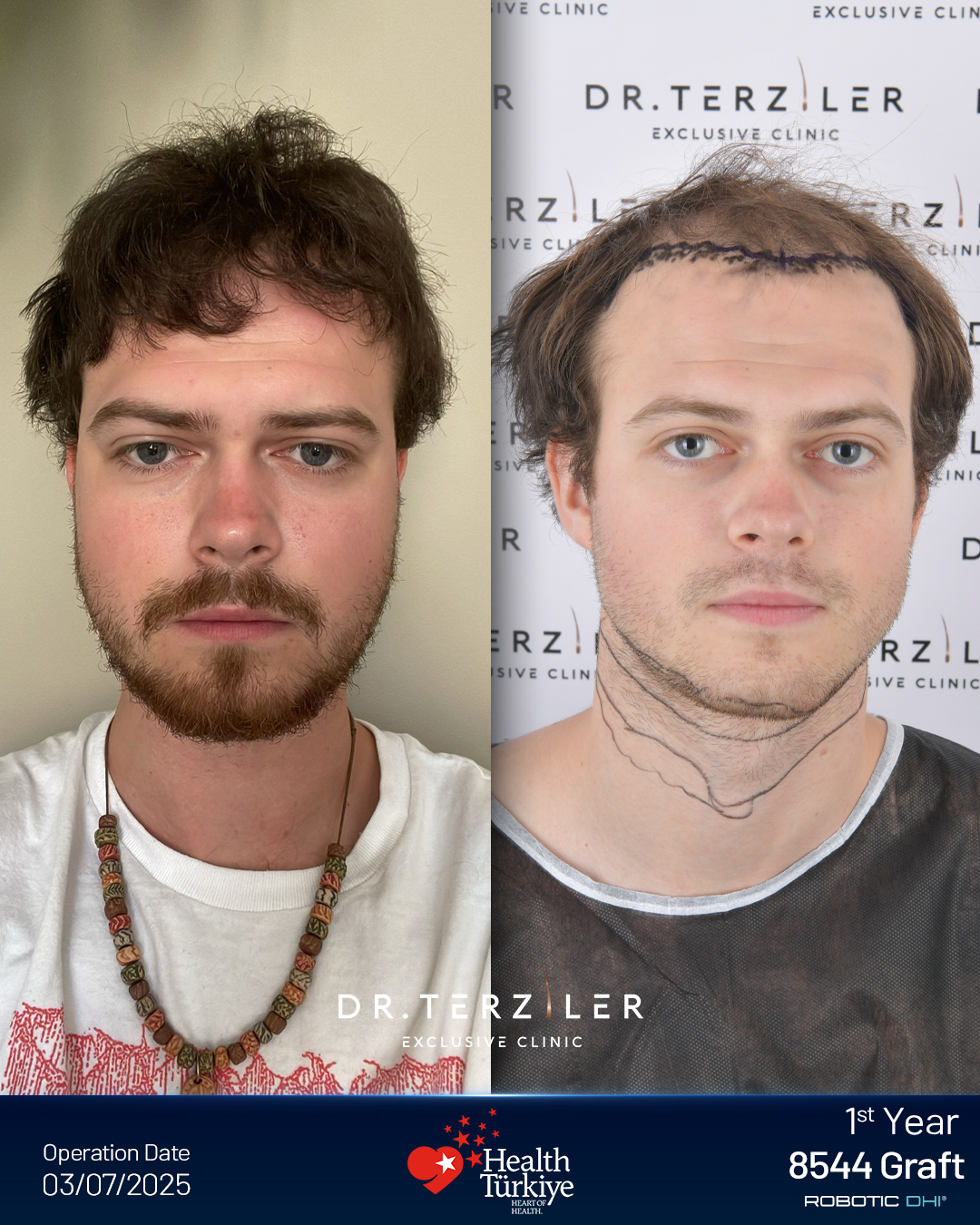 Hair transplant Turkey before and after result,Hlib from Ukraine, Picasso Robotic DHI, 8,544 grafts, Norwood 6 mega-session case study at Dr. Terziler Exclusive Clinic