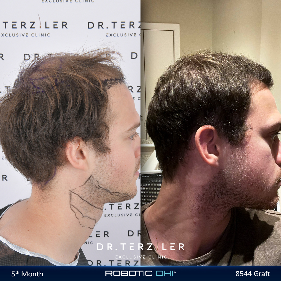 Hair transplant in your 20s before and after result, natural conservative hairline for a young male patient at Dr. Terziler Exclusive Clinic in Istanbul