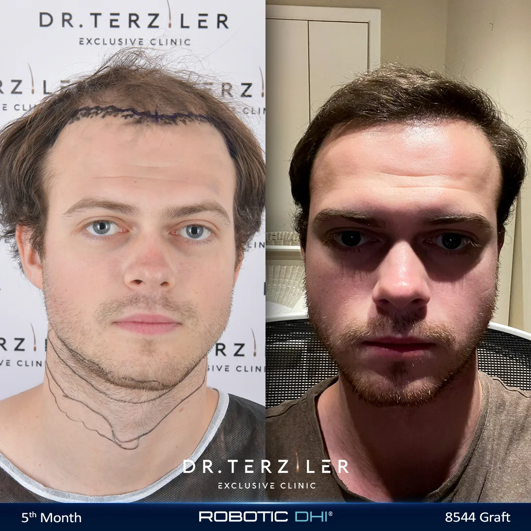 Young male hair transplant before and after at Dr. Terziler Exclusive Clinic, showing a stabilised early hairline restored once hair loss settled, an example of the right age for a hair transplant in a young patient