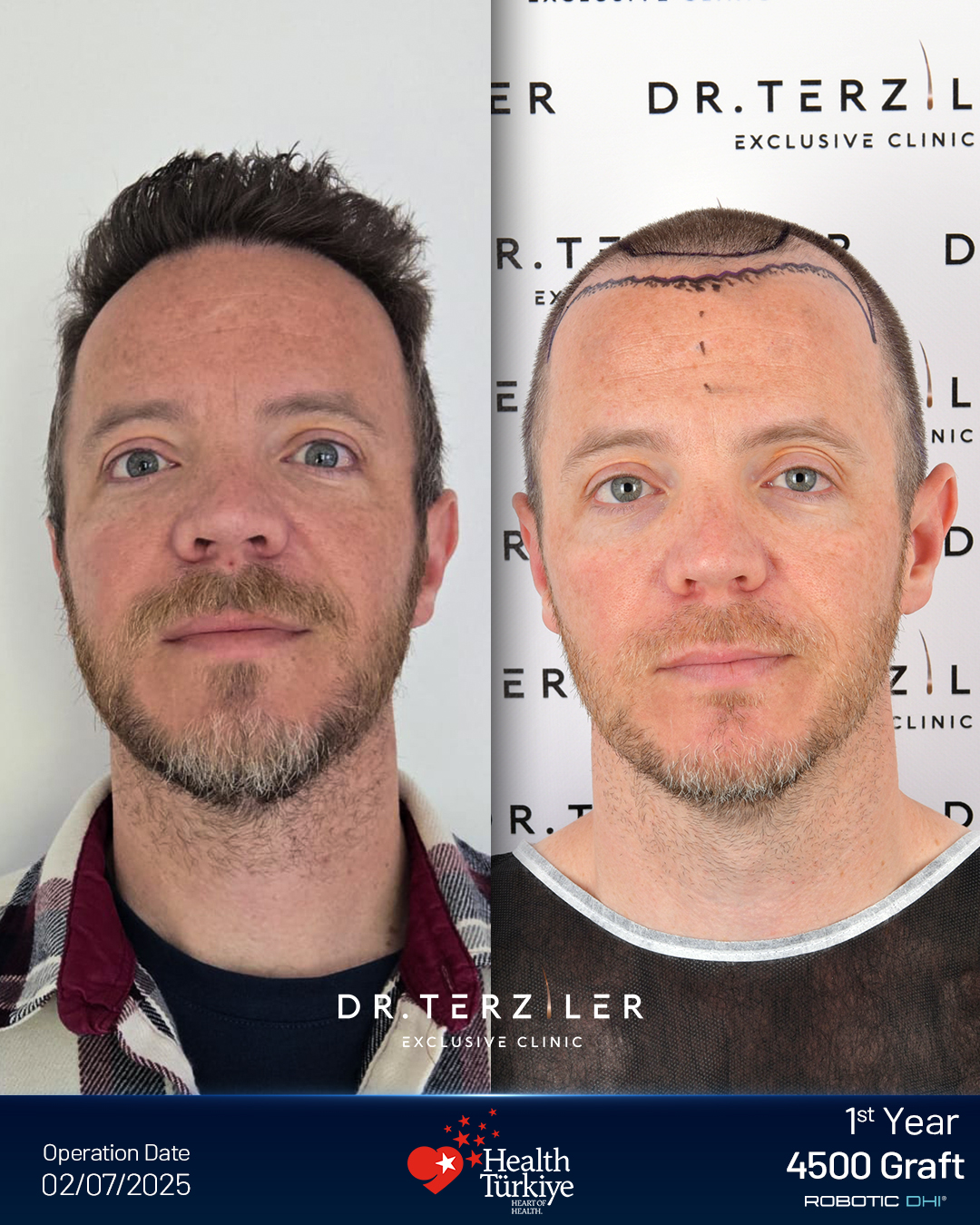 Hair transplant Turkey before and after result,Jobin from India, Robotic DHI, 4,500 grafts, Norwood 4 case study at Dr. Terziler Exclusive Clinic