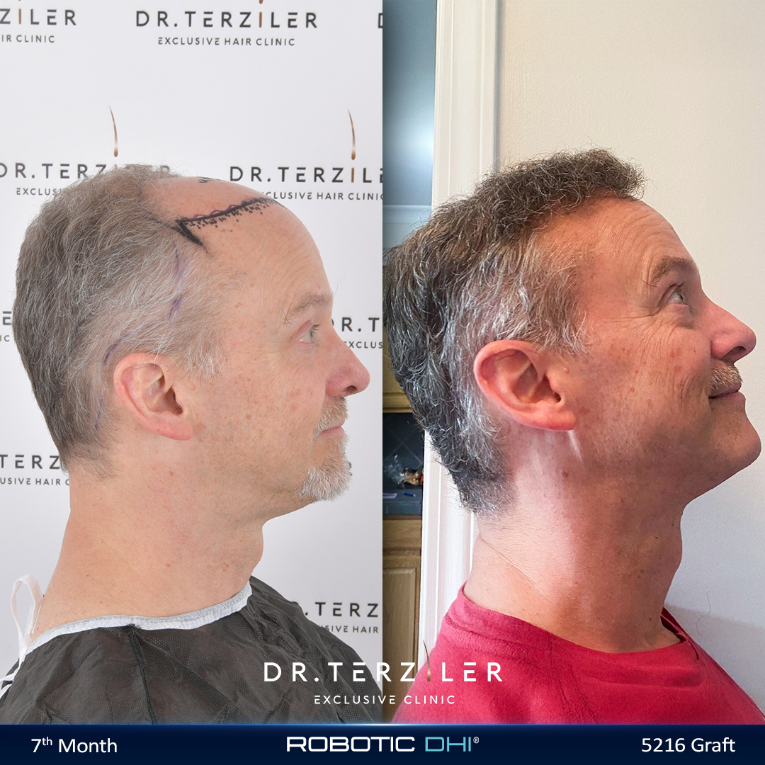 Hair transplant after 50 before and after at Dr. Terziler Exclusive Clinic, proving it is not too late for a hair transplant for an older male patient with a fully stable hair loss pattern