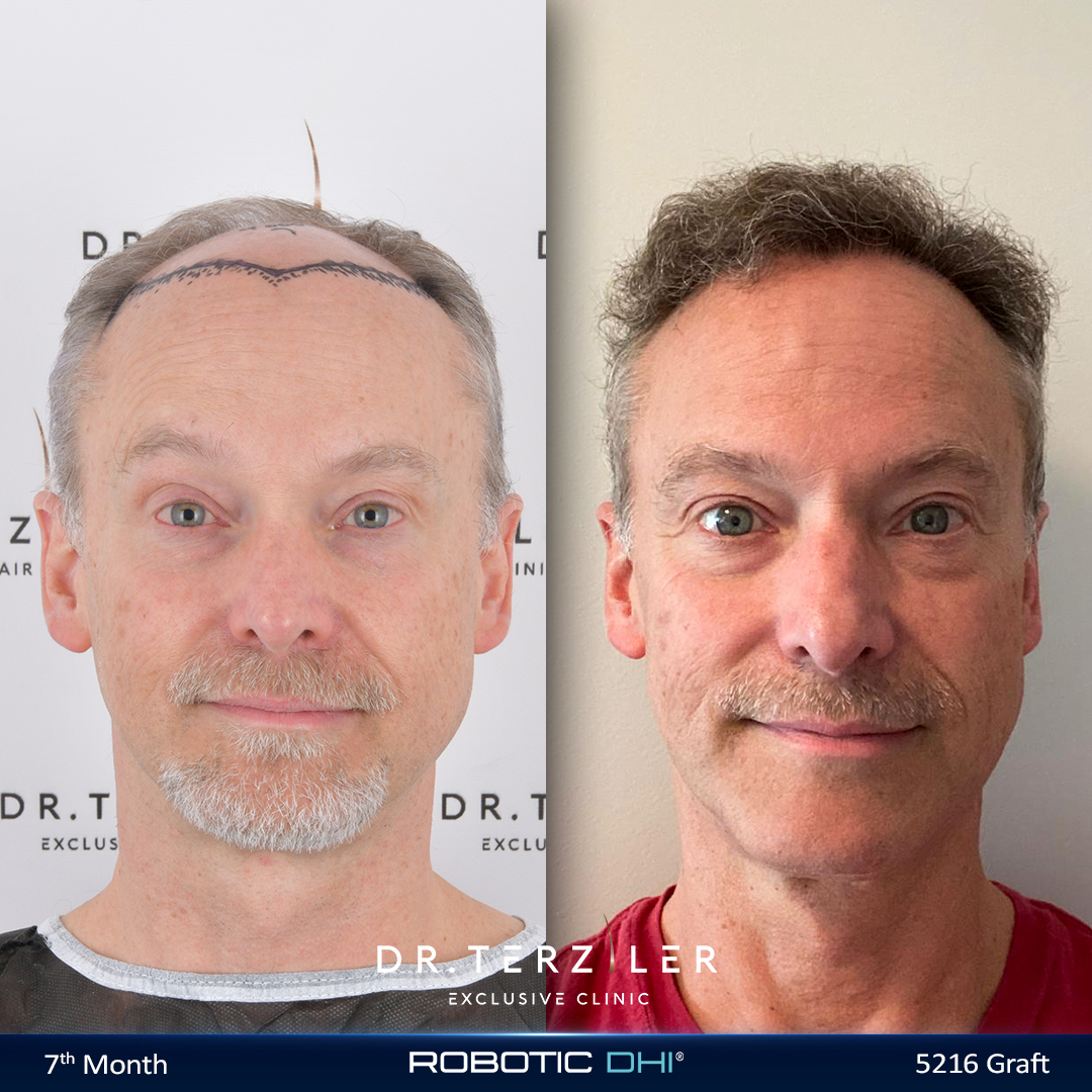 Older man hair transplant before and after result, natural density restored after age 50, no age limit for a hair transplant at Dr. Terziler Exclusive Clinic Istanbul