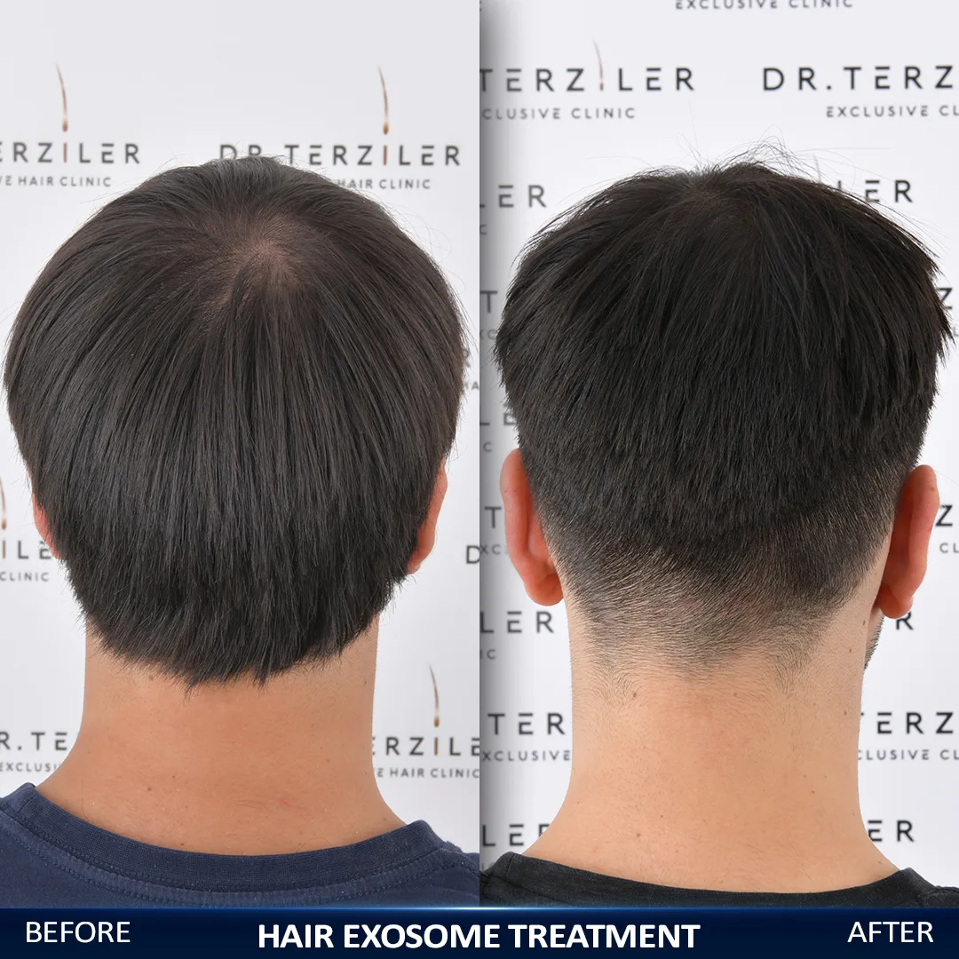 Exosome therapy for men's hair loss before and after at Dr. Terziler Exclusive Clinic, Turkey — thicker hair across a thinning crown