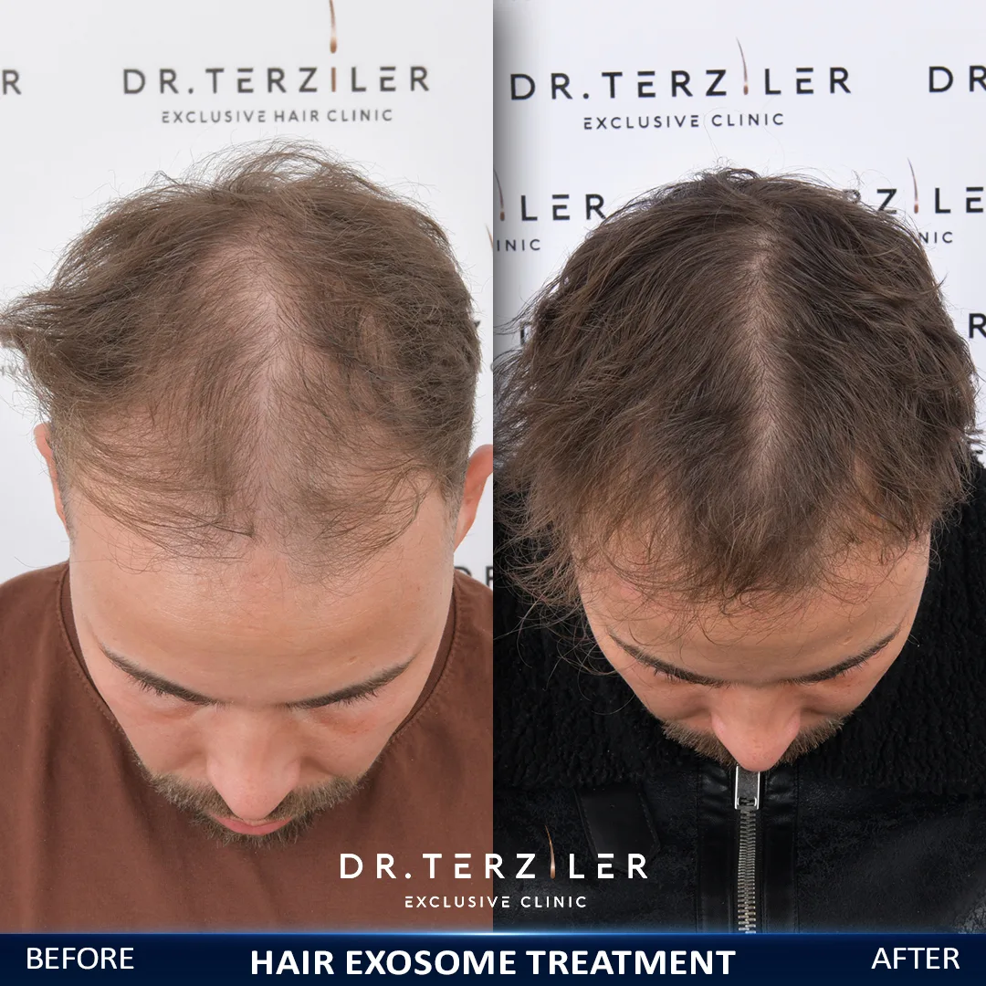 Exosome hair therapy before and after results for a male patient with crown thinning at Dr. Terziler Exclusive Clinic, Istanbul — denser hair after exosome treatment for hair loss