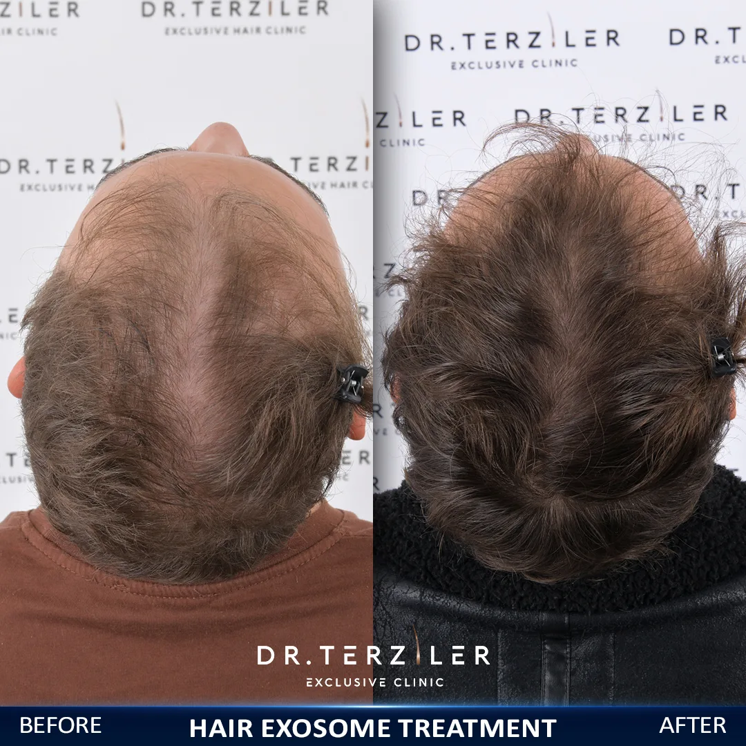 Male exosome treatment for hair loss before and after at Dr. Terziler Exclusive Clinic — reduced shedding and fuller mid-scalp density