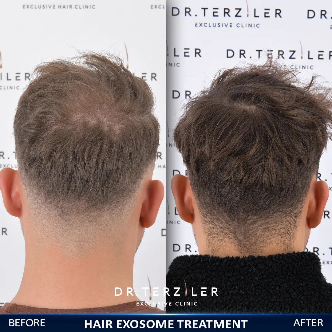 Exosome hair loss treatment before and after for a man at Dr. Terziler Exclusive Clinic, Turkey — thicker hair across a thinning hairline
