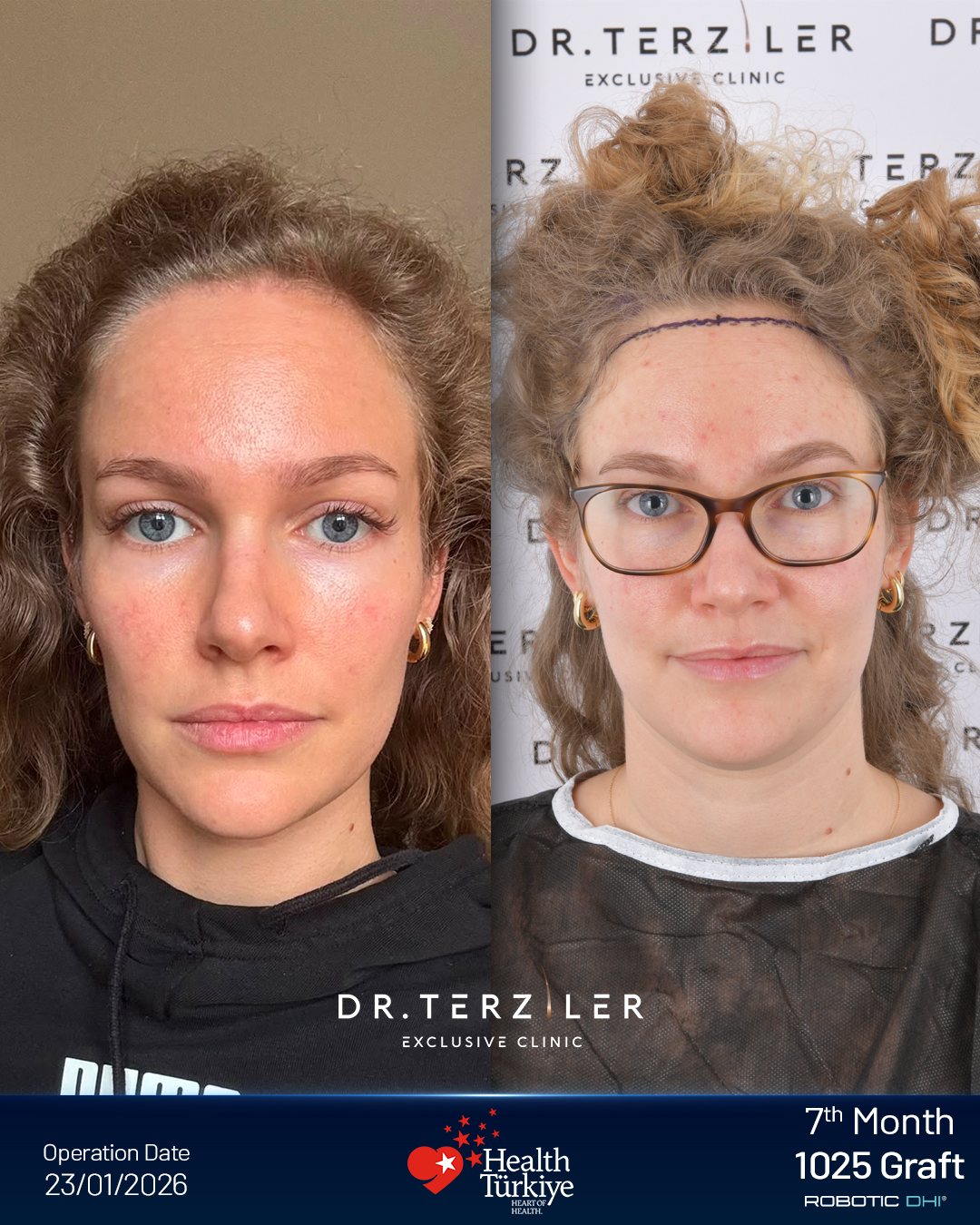 Female hair transplant Turkey before and after,Nadina from Germany, Robotic DHI, 1,025 grafts, hairline and temple restoration case study at Dr. Terziler Exclusive Clinic
