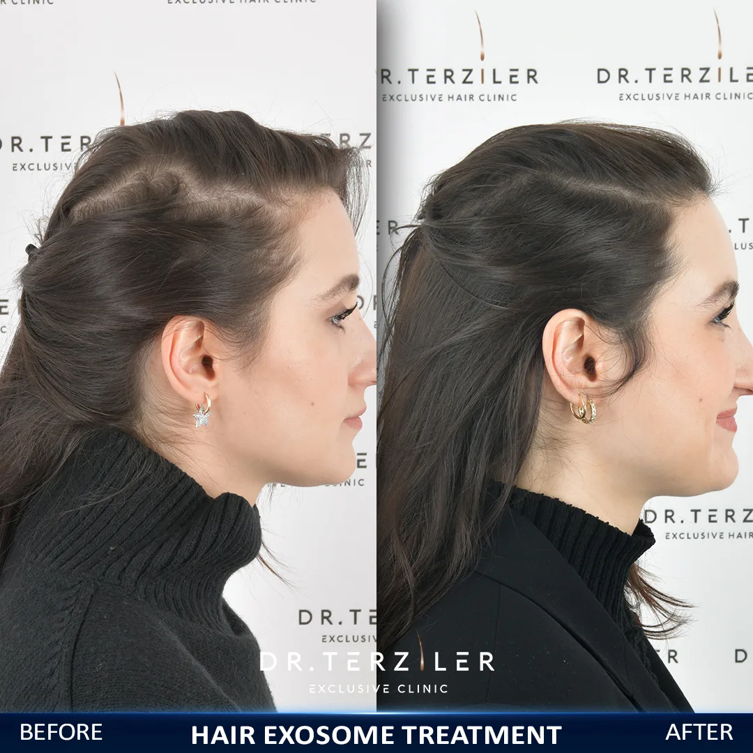 Best hair treatment results for women by Dr. Terziler Exclusive Clinic. Hair exosome treatment before and after pictures show a high density and growing in the hair and scalp of female patient.