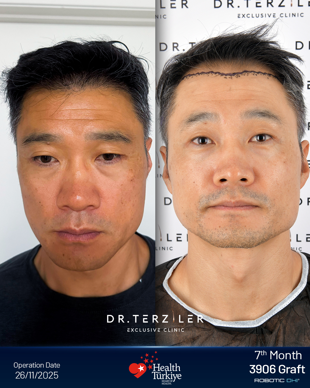 Asian hair transplant Turkey before and after,Tae from South Korea, Robotic DHI, 1,396 grafts, Norwood 2 hairline case study at Dr. Terziler Exclusive Clinic