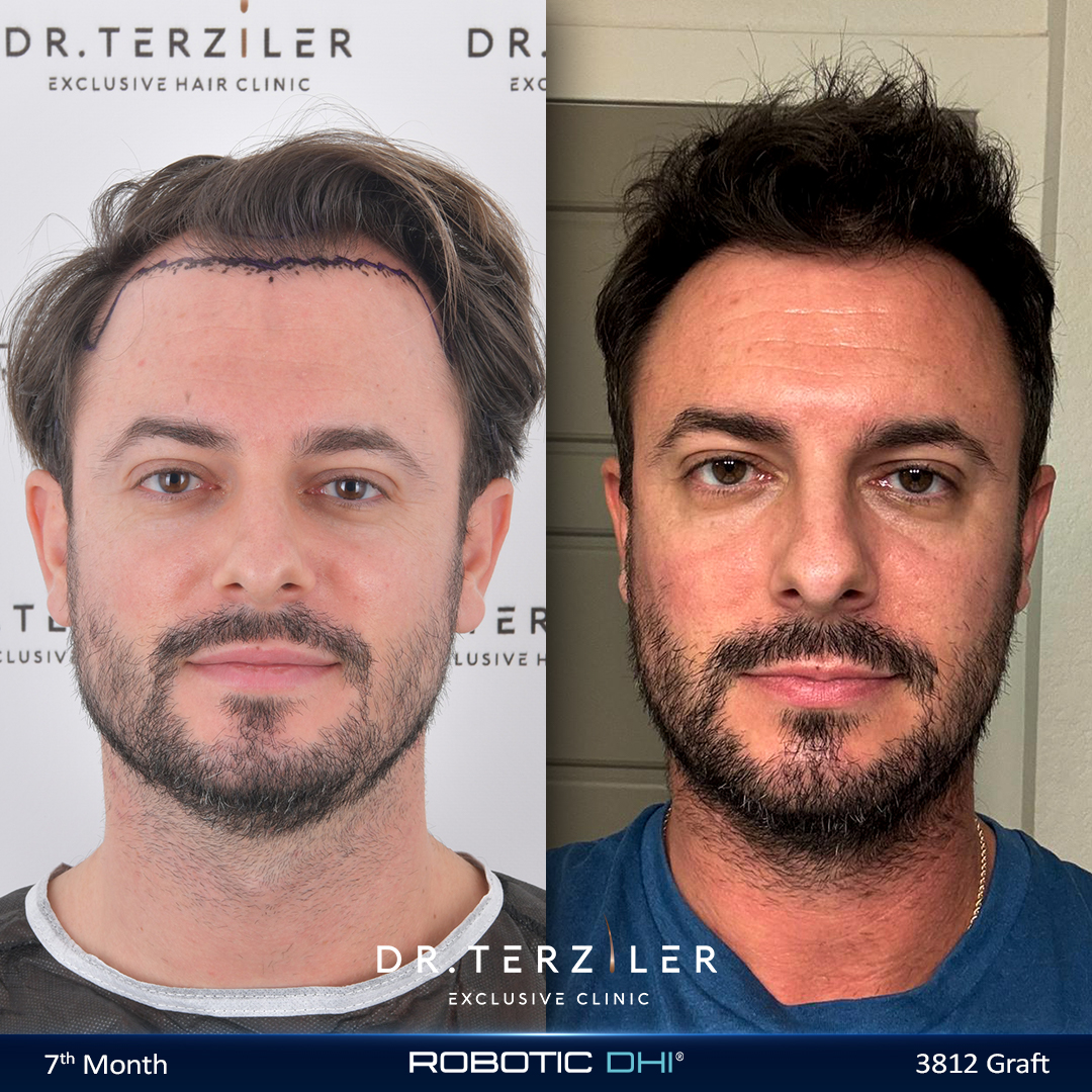 Hair transplant Turkey before and after result,Tomas M. from the UK, Picasso Robotic DHI, 3,812 grafts, Norwood 3 case study at Dr. Terziler Exclusive Clinic