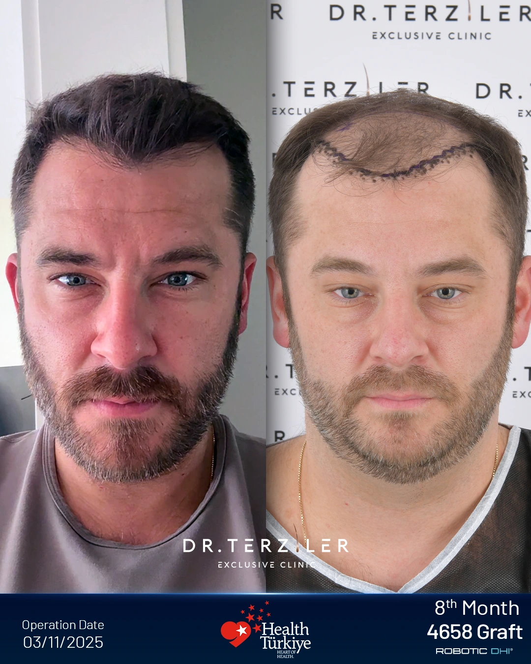 Corey David Williams hairline comparison after Robotic DHI at Dr. Terziler Exclusive Clinic: 8-month result on the left and preoperative marked hairline on the right; 4,658 grafts.