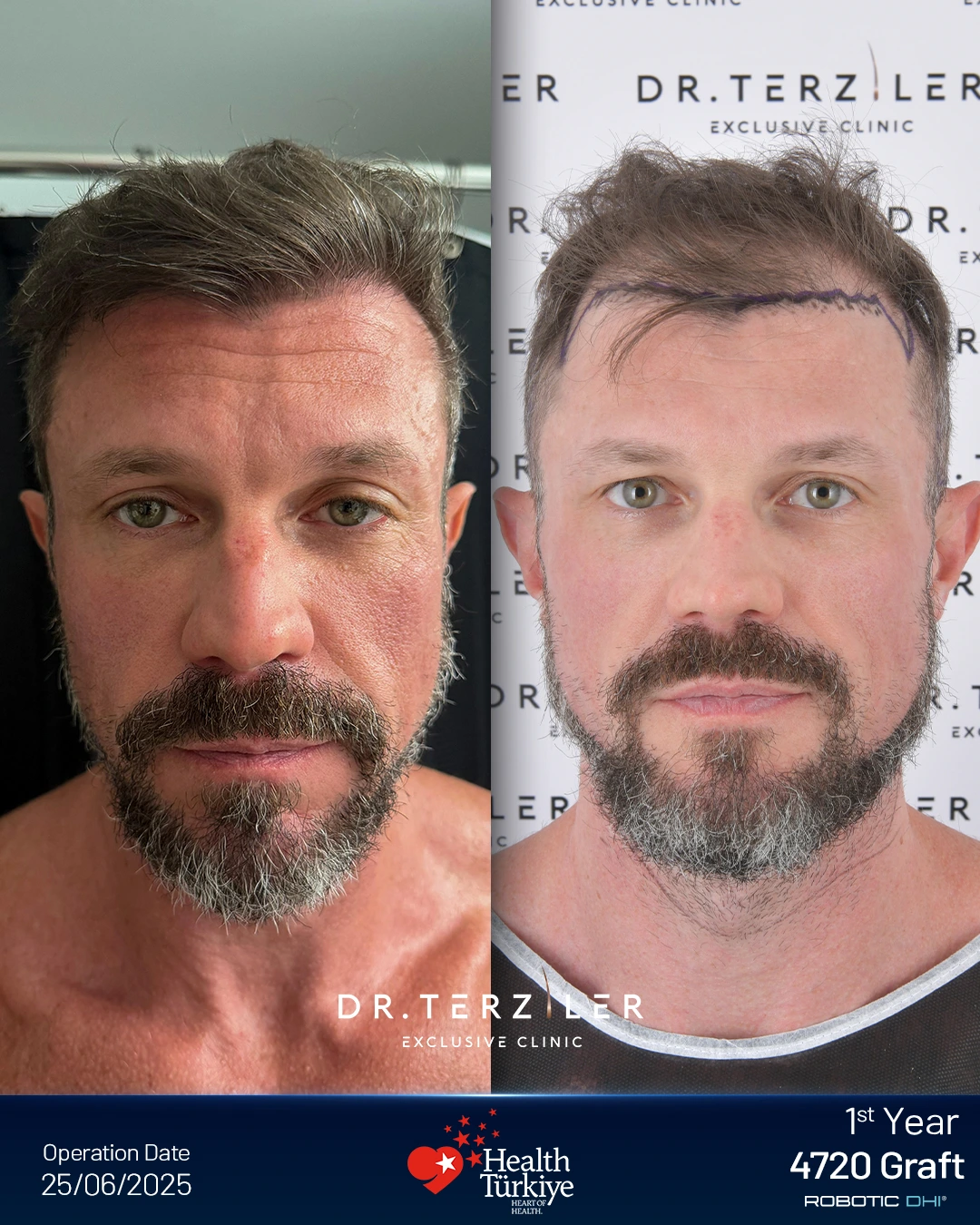 Sean Joseph hairline comparison after Robotic DHI at Dr. Terziler Exclusive Clinic: 12-month result on the left and preoperative marked hairline on the right; 4,720 grafts.