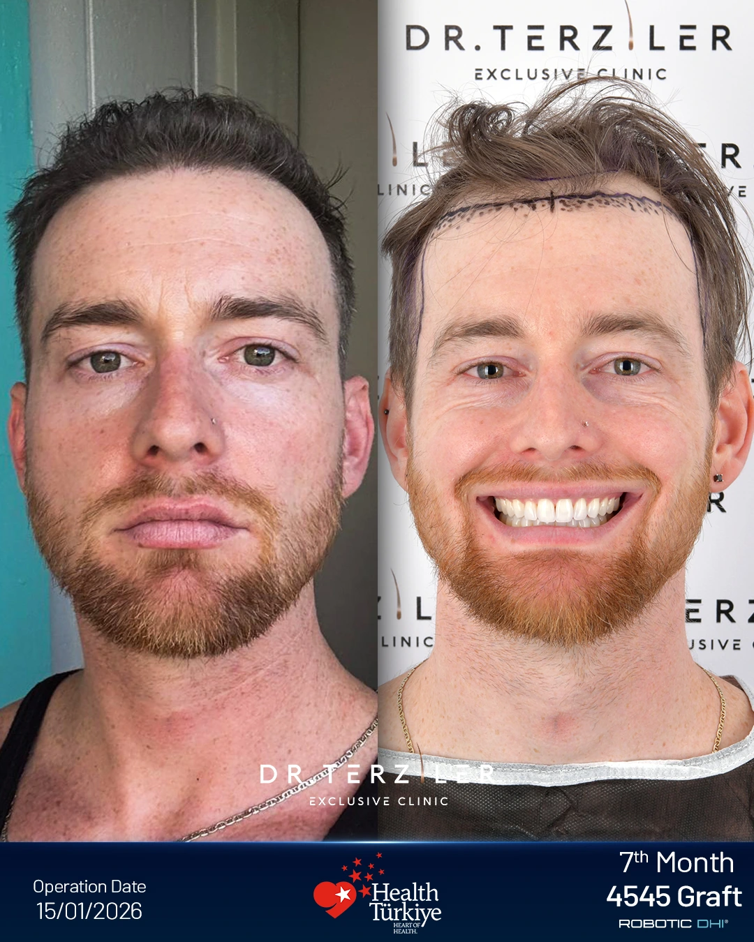 Connell hairline comparison after Robotic DHI at Dr. Terziler Exclusive Clinic: 7-month result on the left and preoperative marked hairline on the right; 4,545 grafts.