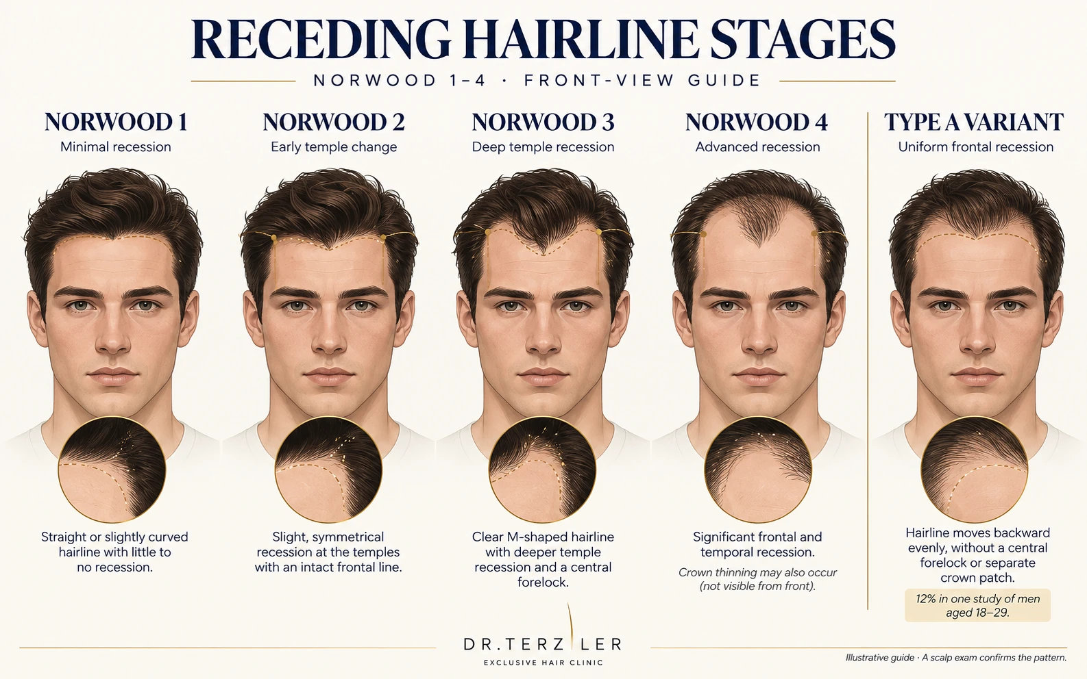 Front-view illustrations of Norwood I to IV hairline patterns and a type A frontal-recession variant.