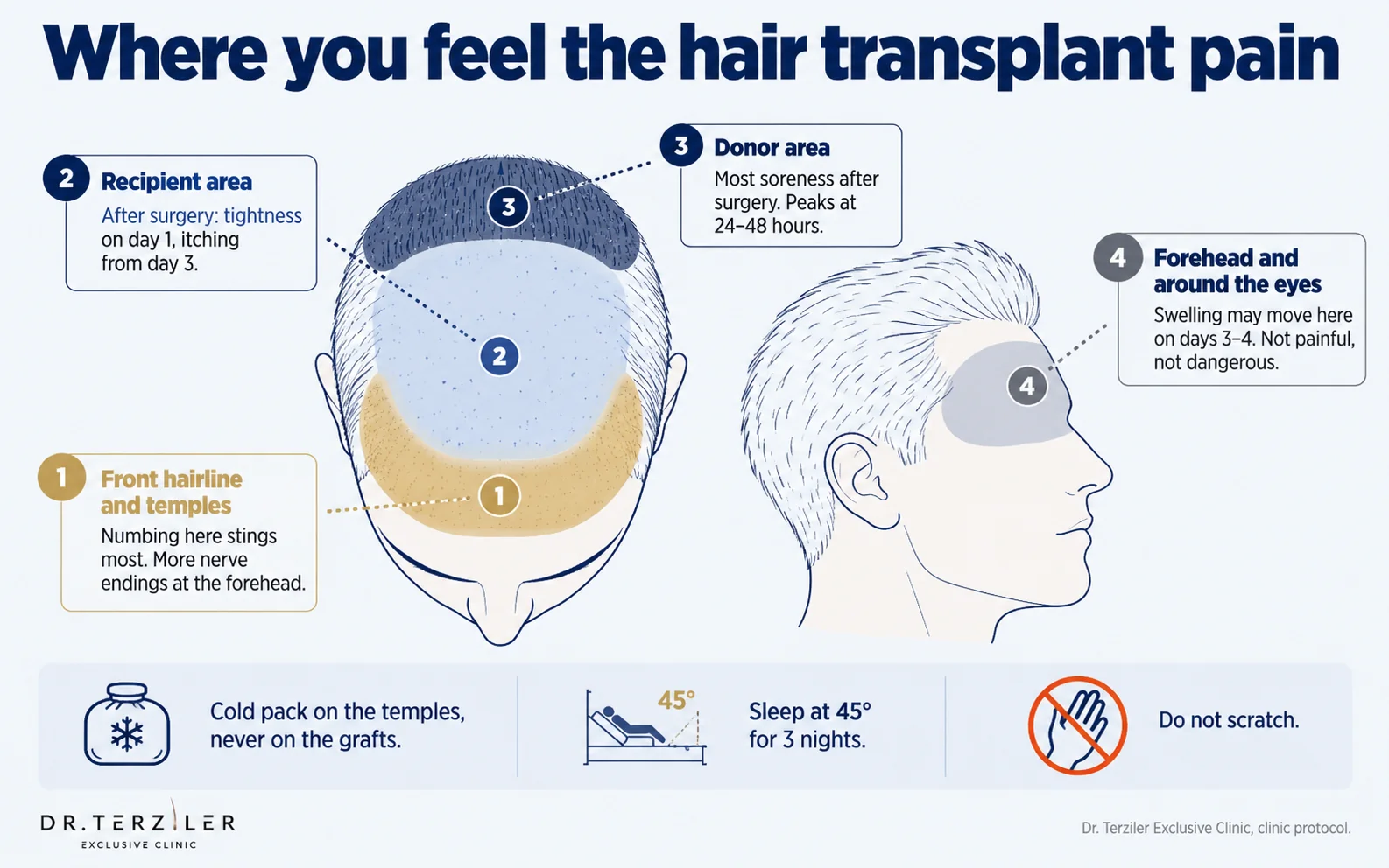 Head diagram of hair transplant discomfort: numbing stings most at the front hairline and temples, the donor area at the back is sorest for 24 to 48 hours, the recipient area itches from day 3, and swelling may reach the forehead and eyes on days 3 to 4.